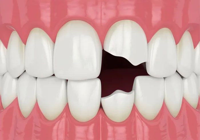 Illustration of a broken front tooth after an injury, emergency dentist in Oldsmar, FL