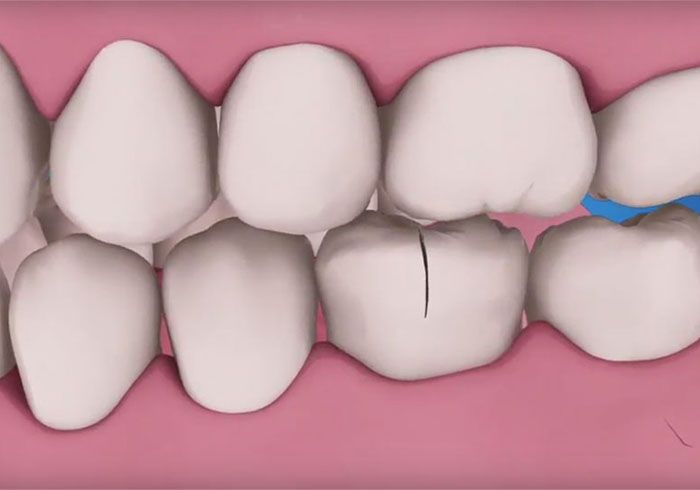 Illustration of a cracked molar, emergency dentist in Oldsmar, FL