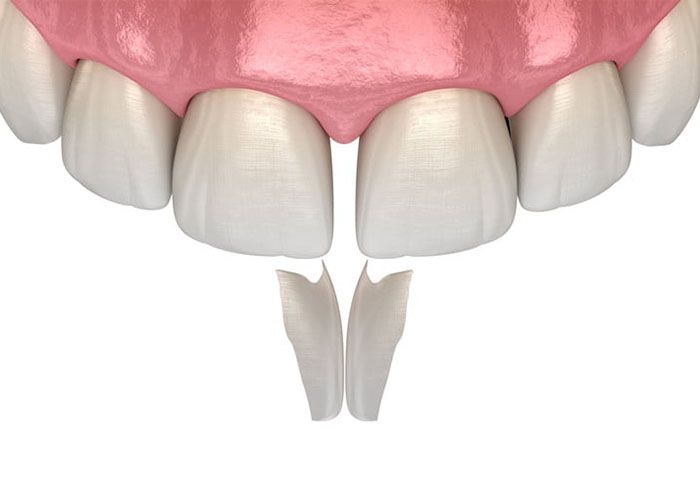Illustration of dental bonding closing a gap between front teeth, cosmetic dentistry in Dunedin Isles, FL