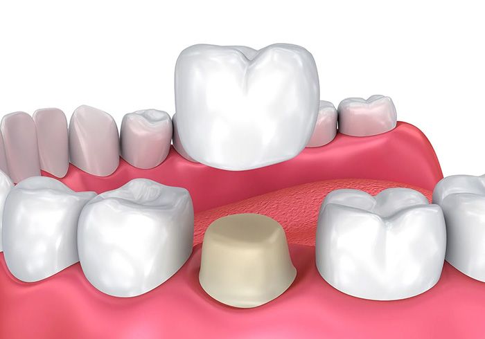 Illustration of a dental crown fitting over a prepared tooth, veneers in Anna Maria, FL