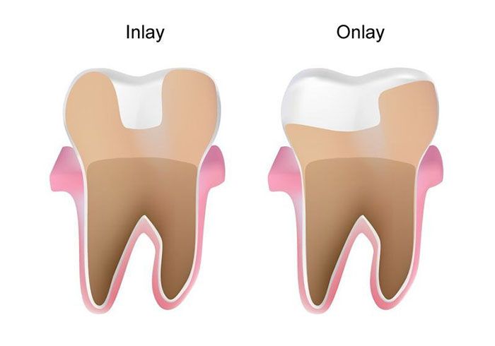 Illustration comparing a dental inlay and an onlay, dental crowns in Bayshore Gardens, FL