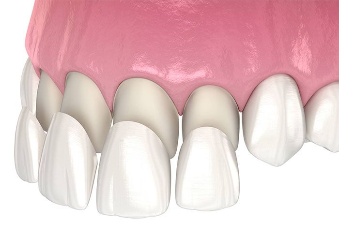 Illustration of porcelain veneers being placed over front teeth, cosmetic dentistry in Palmetto, FL