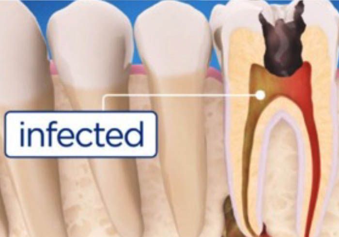 Illustration of an infected tooth root that needs a root canal, dental crowns in Kenneth City, FL
