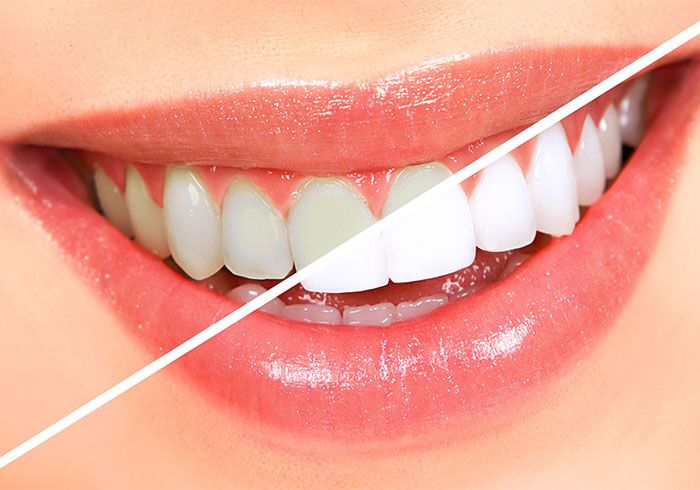 Before-and-after comparison of teeth whitening, veneers in St. Petersburg, FL