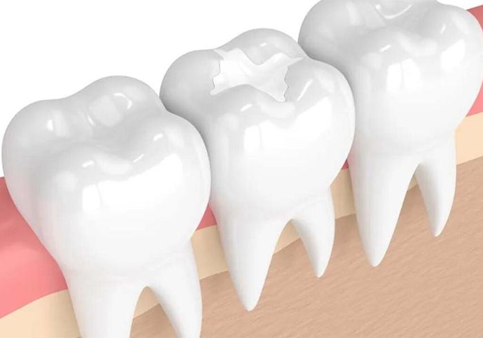 Illustration of a tooth-colored filling in a molar, dentist in Holmes Beach, FL